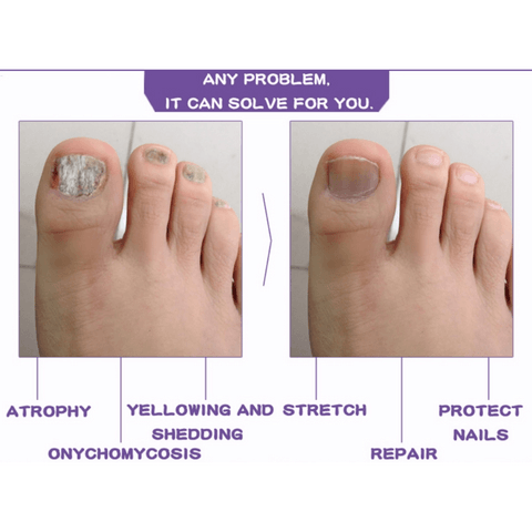 Nail Serum for Long healthy & fungus free nails - Liveonease