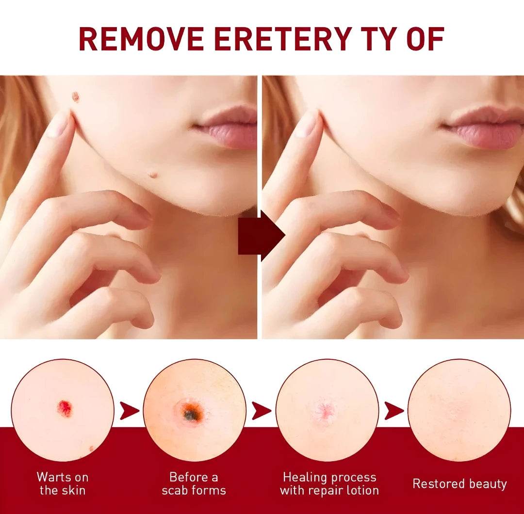 Tags & Moles Remover BUY 1 GET 1 FREE - Liveonease