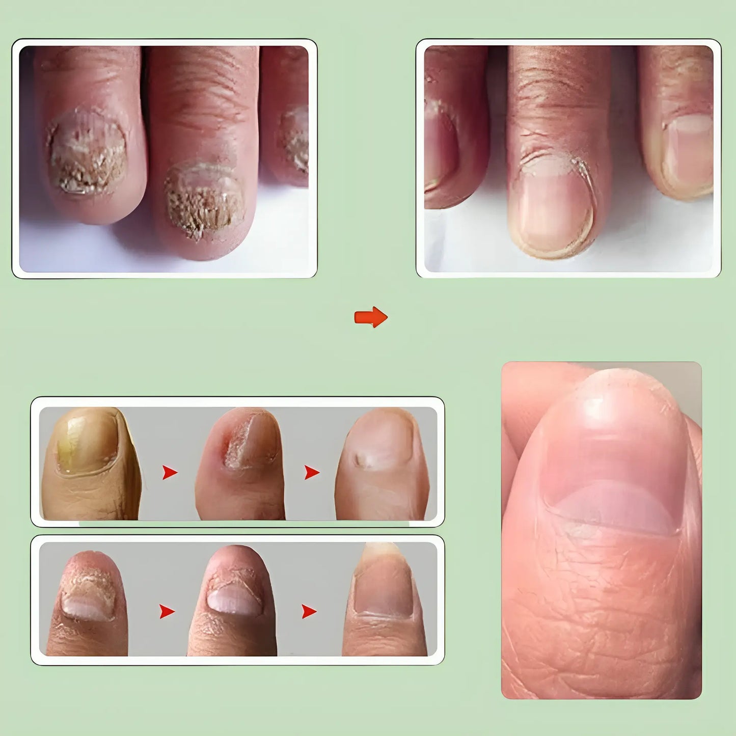 Nail Serum for Long healthy & fungus free nails