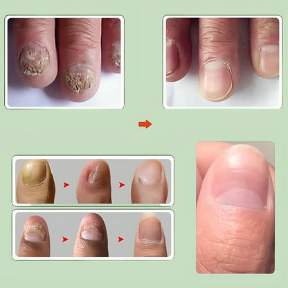 Nail Serum for Long healthy & fungus free nails